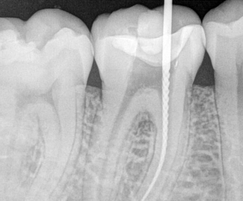root canal in burnaby