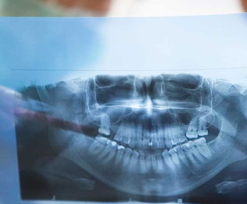 burnaby dental xrays