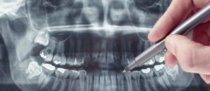 burnaby dental xrays