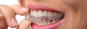 invisalign by burnaby dentist