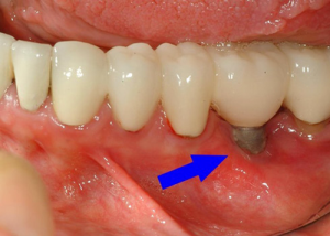 burnaby dental implant problem