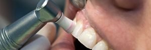dentist teeth cleaning burnaby