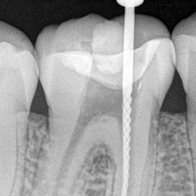 burnaby root canal