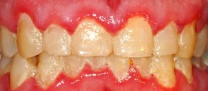 gum disease burnaby bc